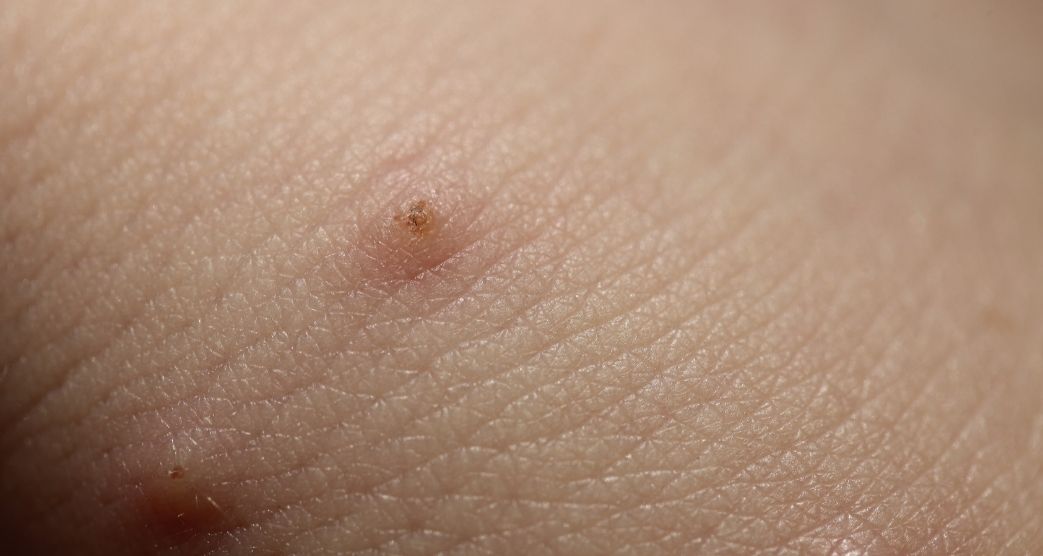 Piqure punaises de lit